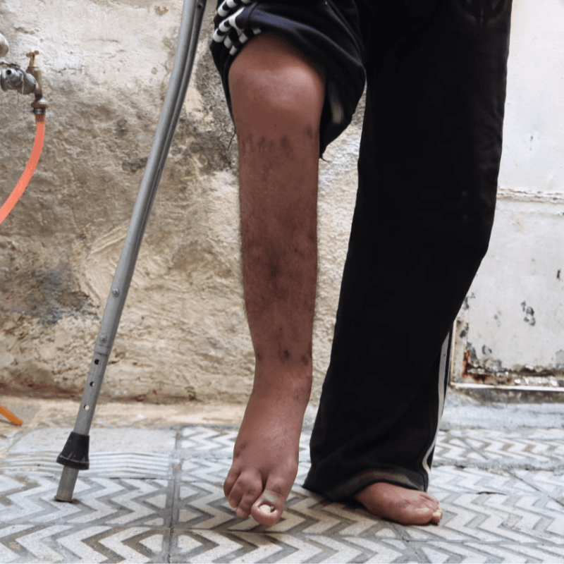 دانیال، پسری که فقط یک جراحی تا ایستادن فاصله دارد