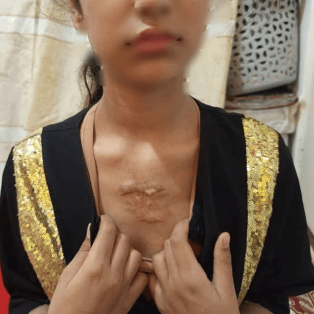 13 سال است که دردِ یک حادثه، کودکیِ ستایش را می‌سوزاند