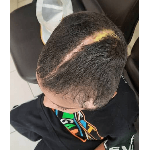 هر بخیه بر جمجمه‌اش، نشانی از جنگیدن برای زندگی‌ست